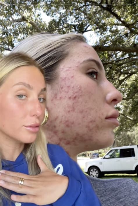 alix earle before accutane|Alix Earle Hints to Having an ‘Accutane Nose Job’